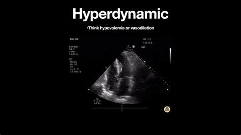 hyperdynamic lv function|hyperdynamic left ventricle stress test.